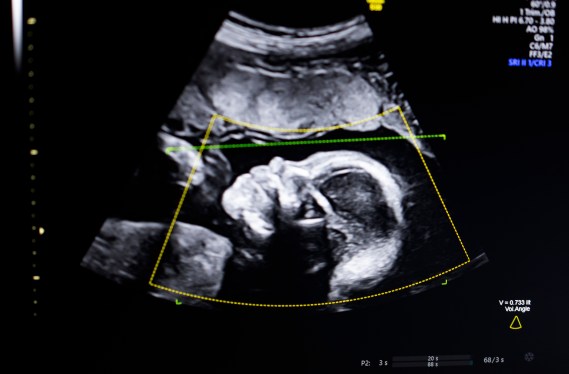 Ultrasound of a baby in a womb